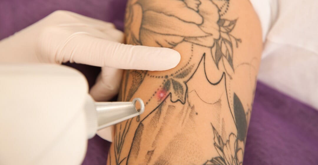 How much is tattoo removal? Here's what that bad ink will cost you
